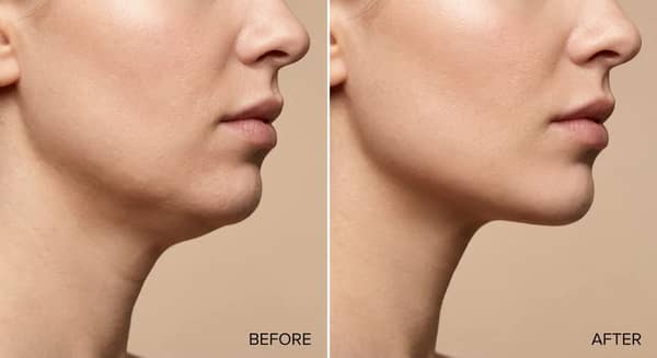 Smart Chin Detection